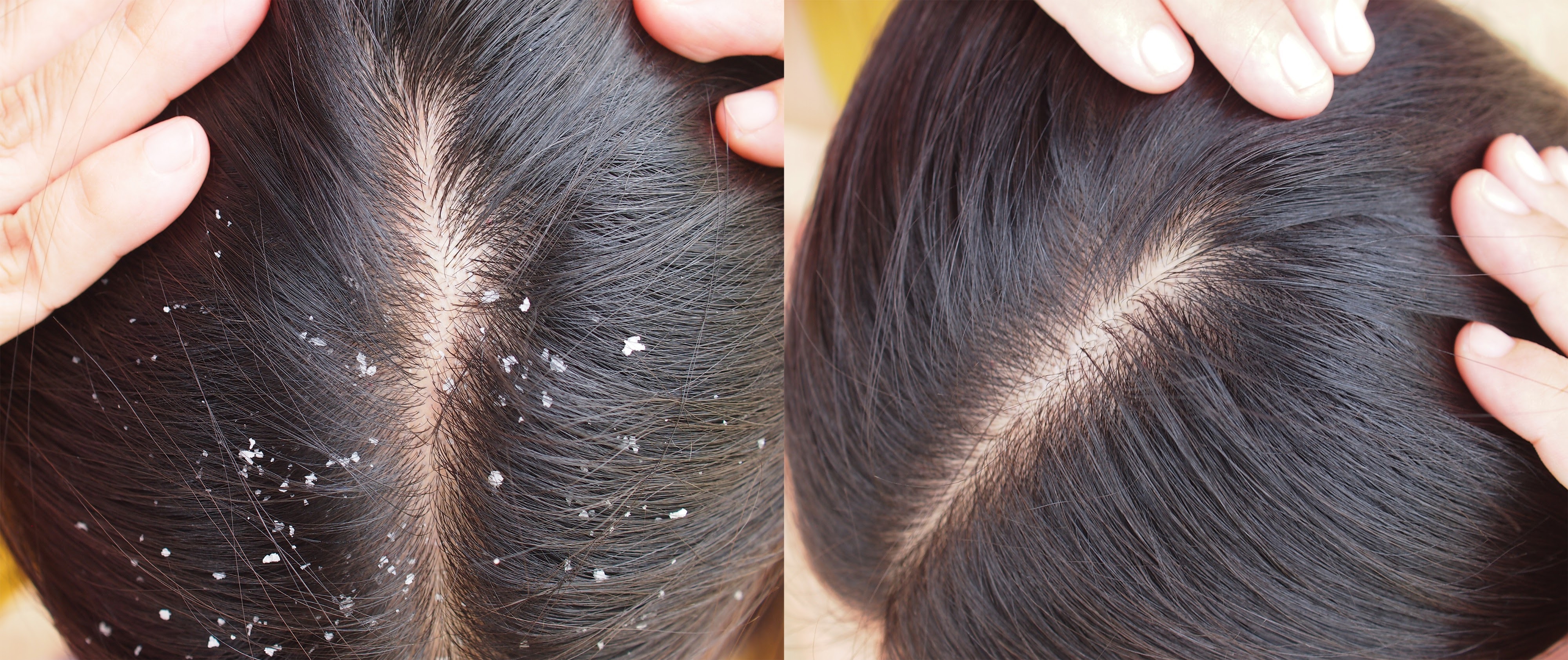 Dandruff Treatment
