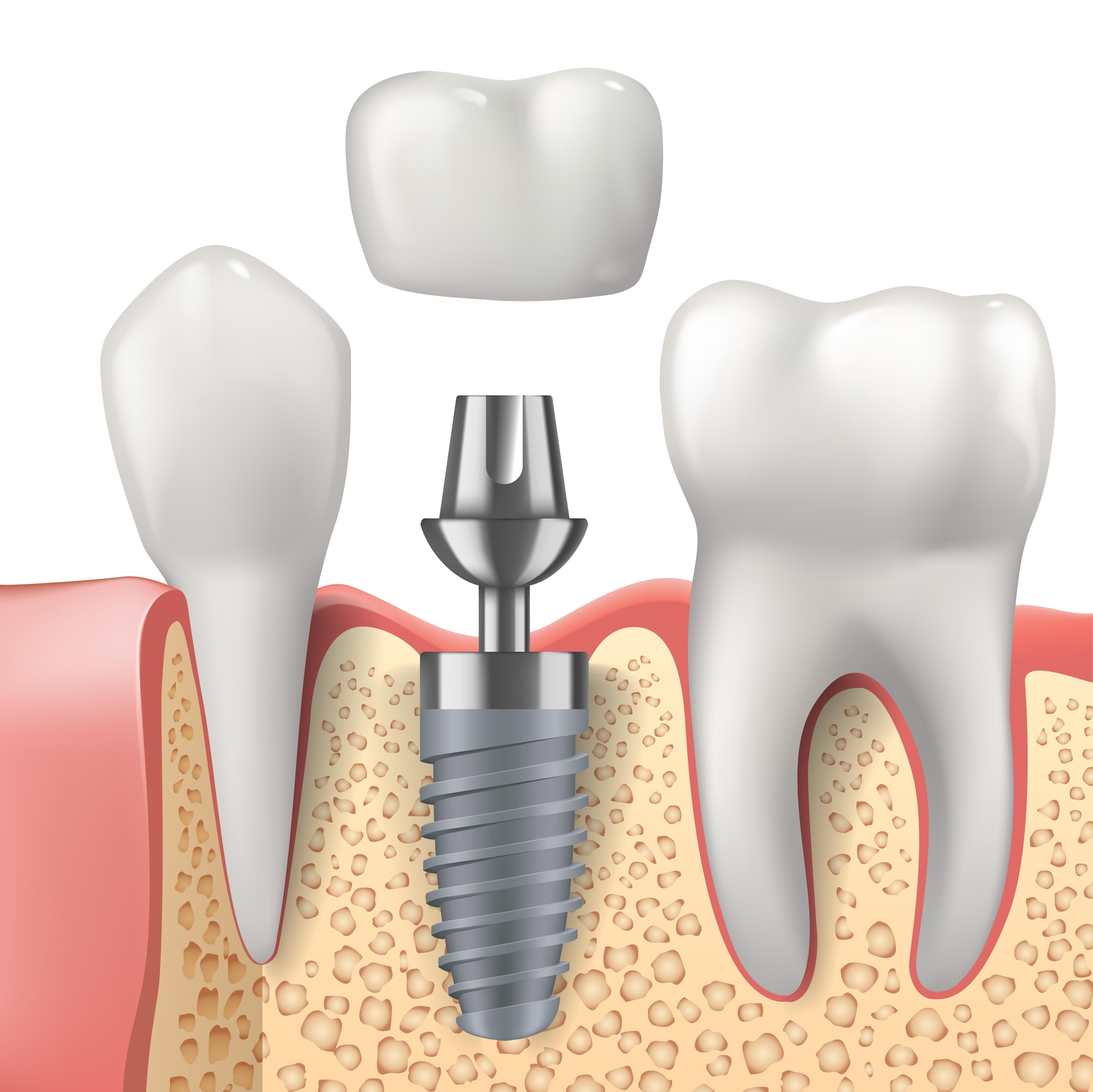 Dental Implants