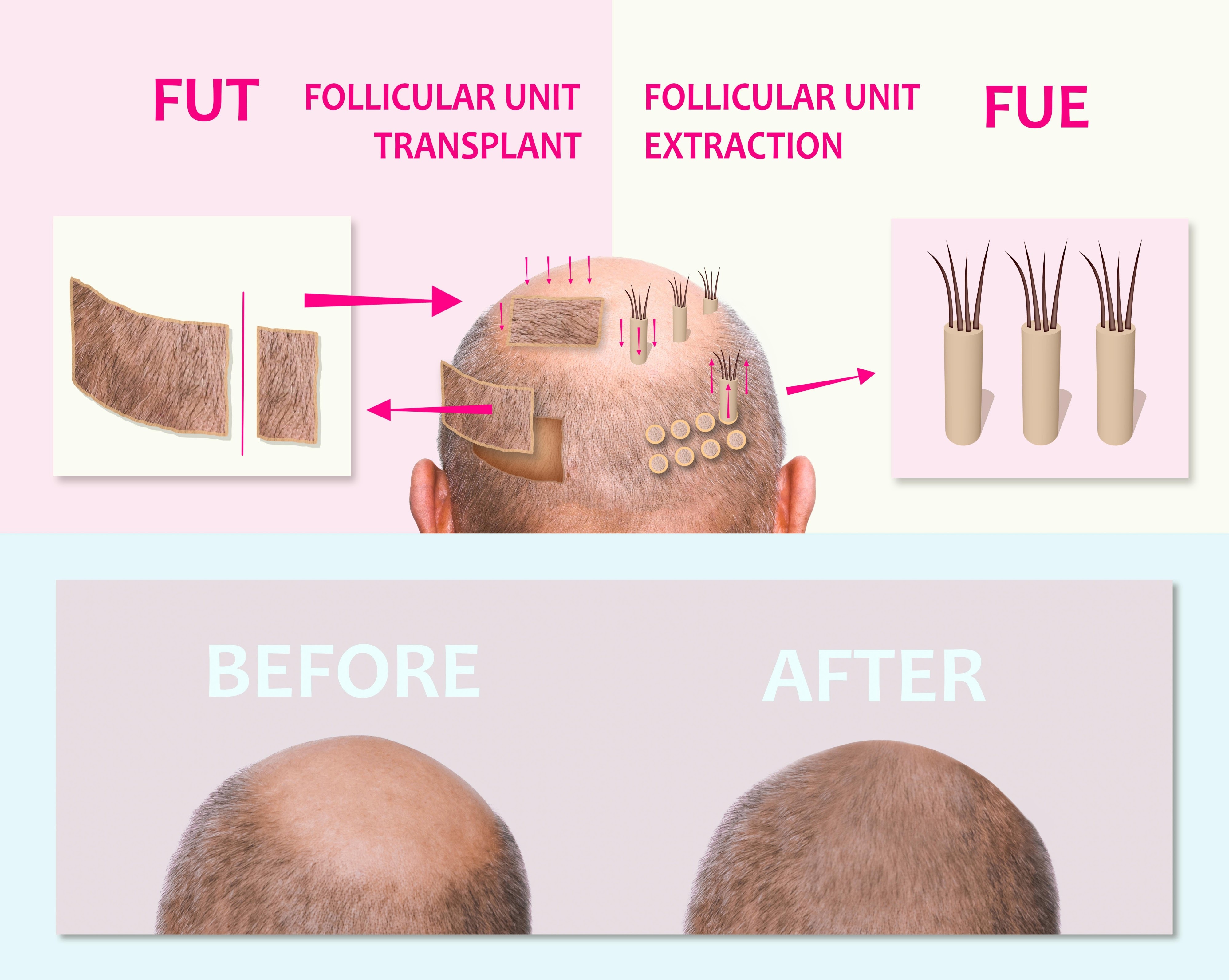 FUT Hair Transplant